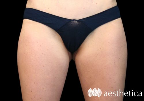 coolsculpting outer thigh after photo