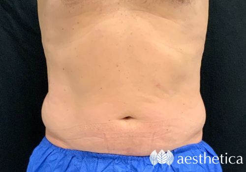 coolsculpting flanks before